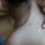 Sarampión en México se dispara en 2026, los casos aumentan 137% y superan cifras de 2025